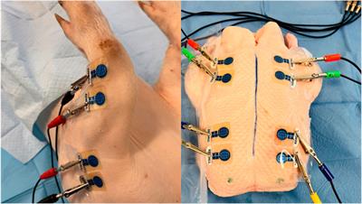 Bioimpedance measurement: a non-invasive diagnosis of limb compartment syndrome